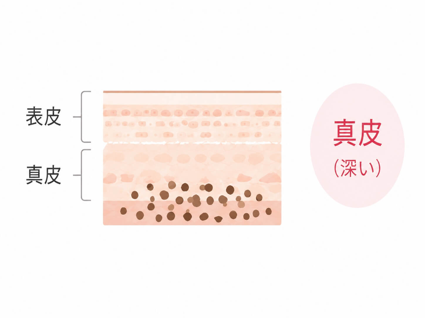 ADMの深さを示す皮膚断面図