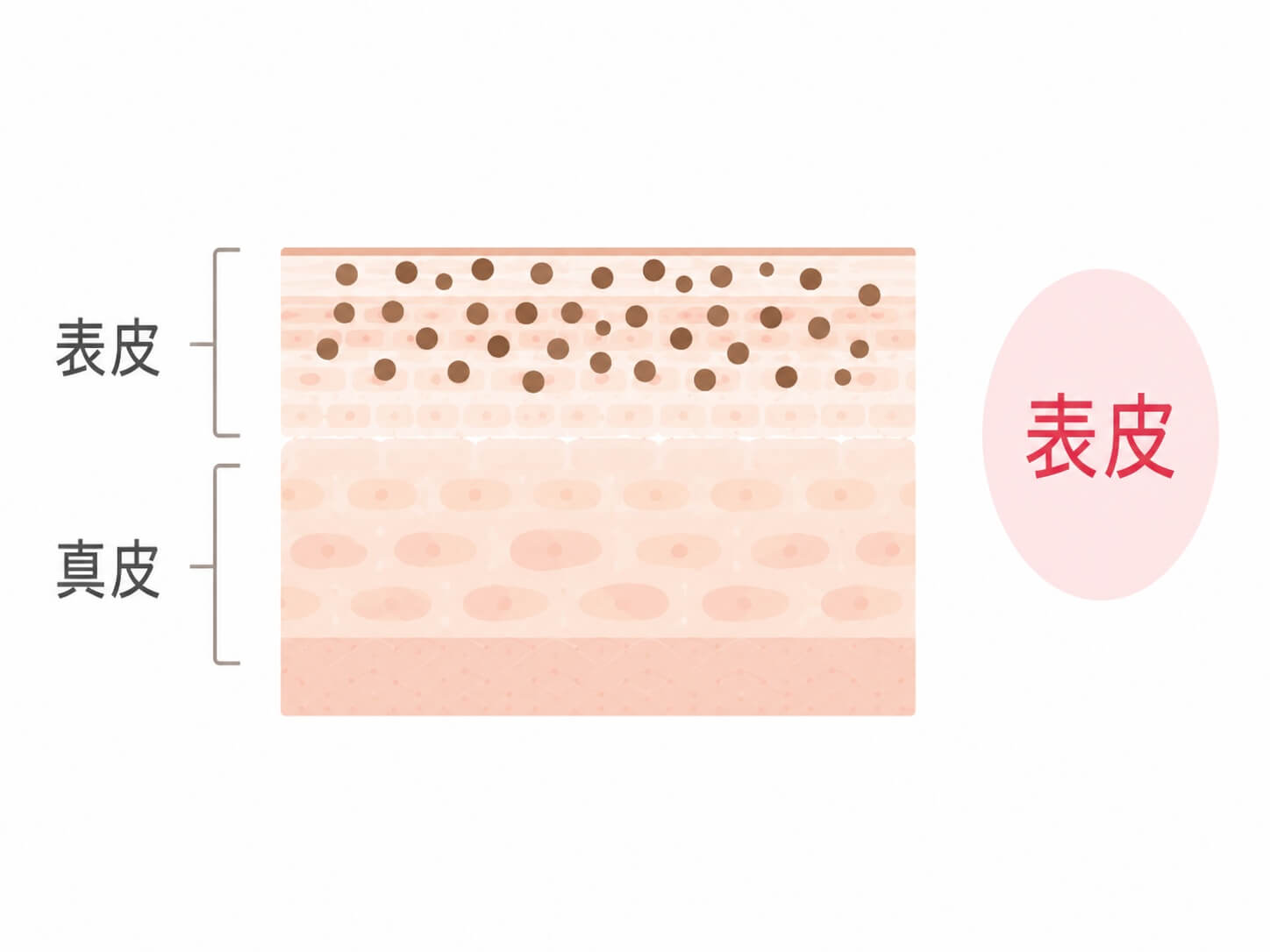 そばかすの深さを示す皮膚断面図