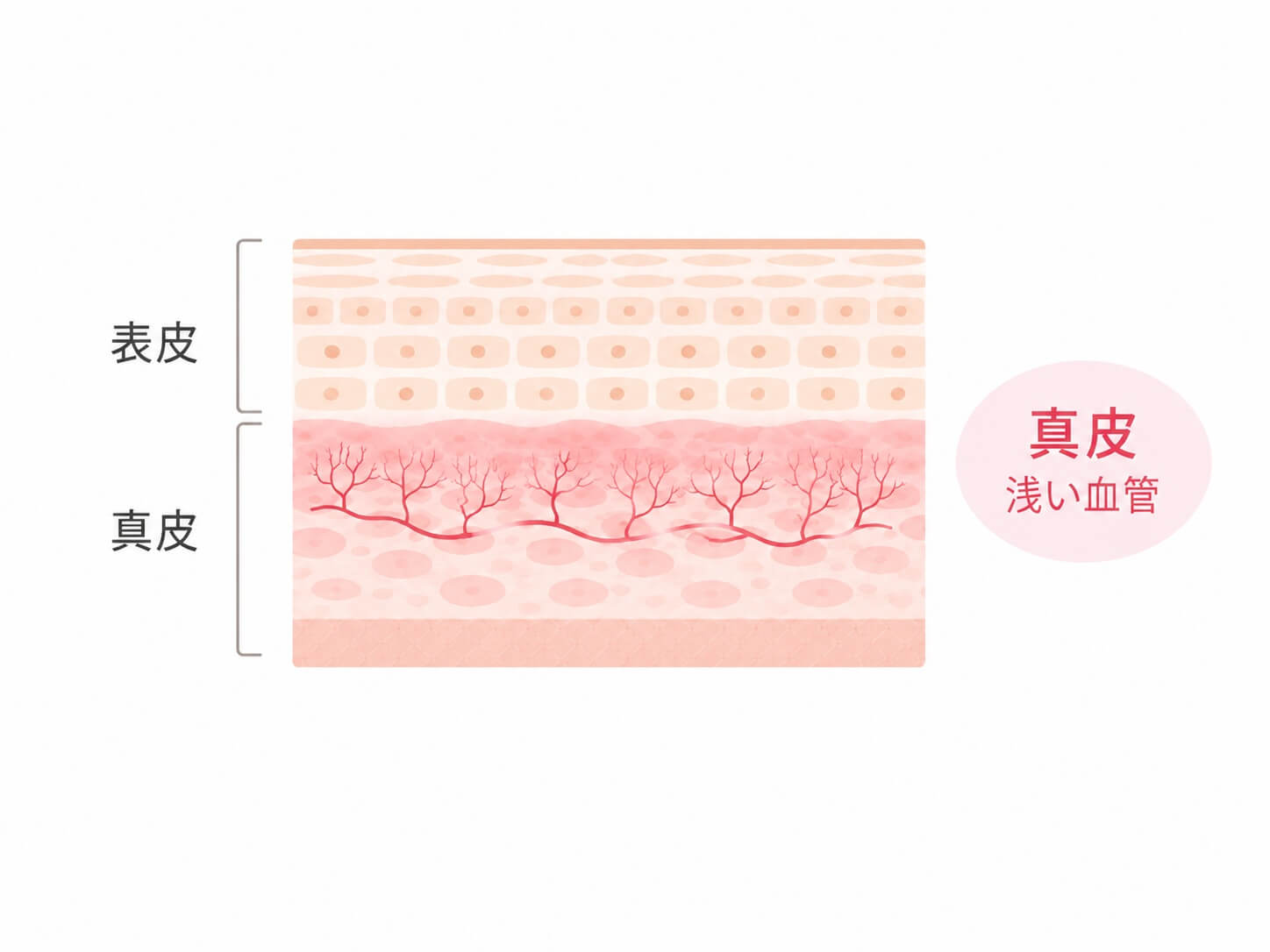 赤ら顔の原因となる浅い血管を示す皮膚断面図