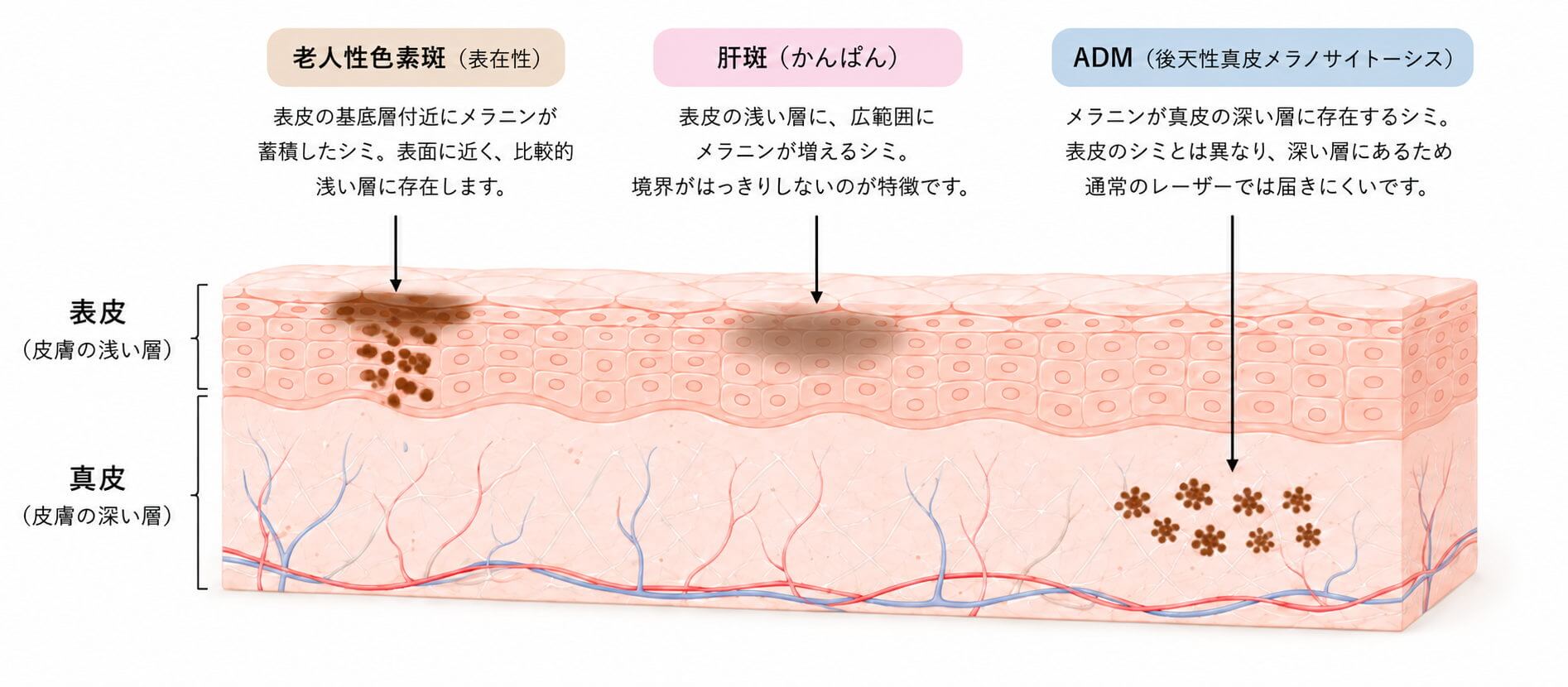 老人性色素斑・肝斑・ADMの深さの違いを示した皮膚断面図