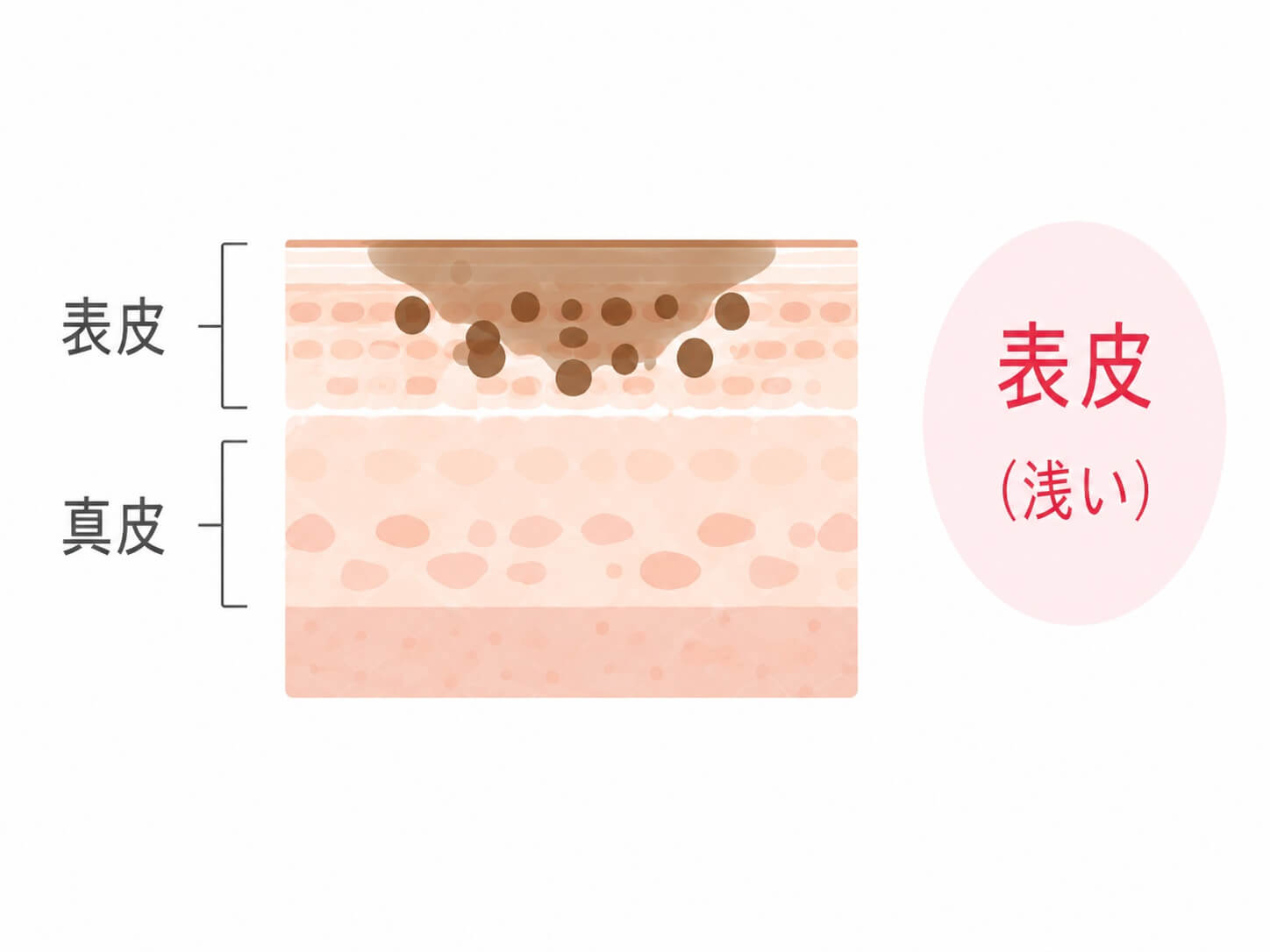 老人性色素斑の深さを示す皮膚断面図