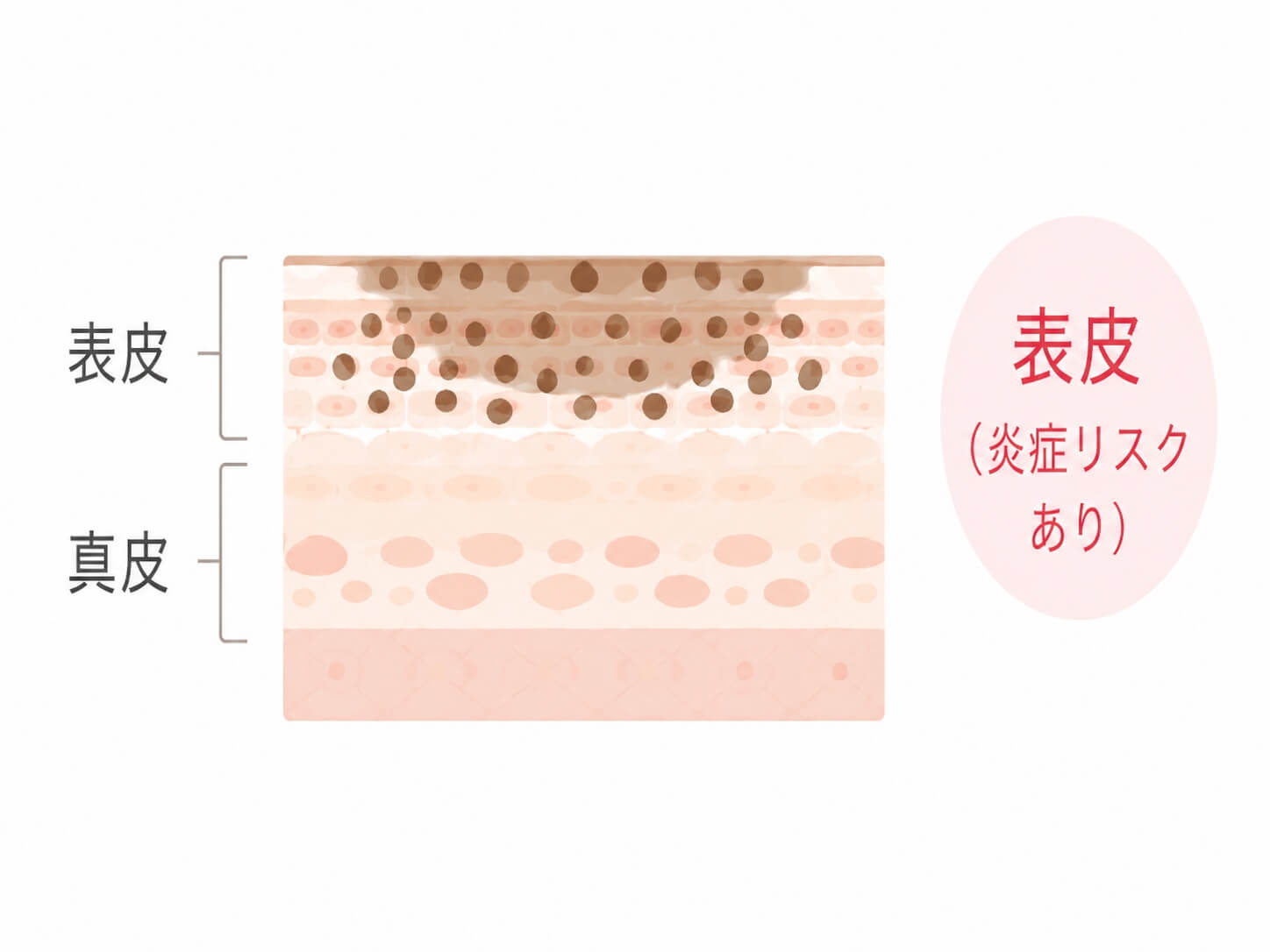 肝斑の深さと炎症リスクを示す皮膚断面図