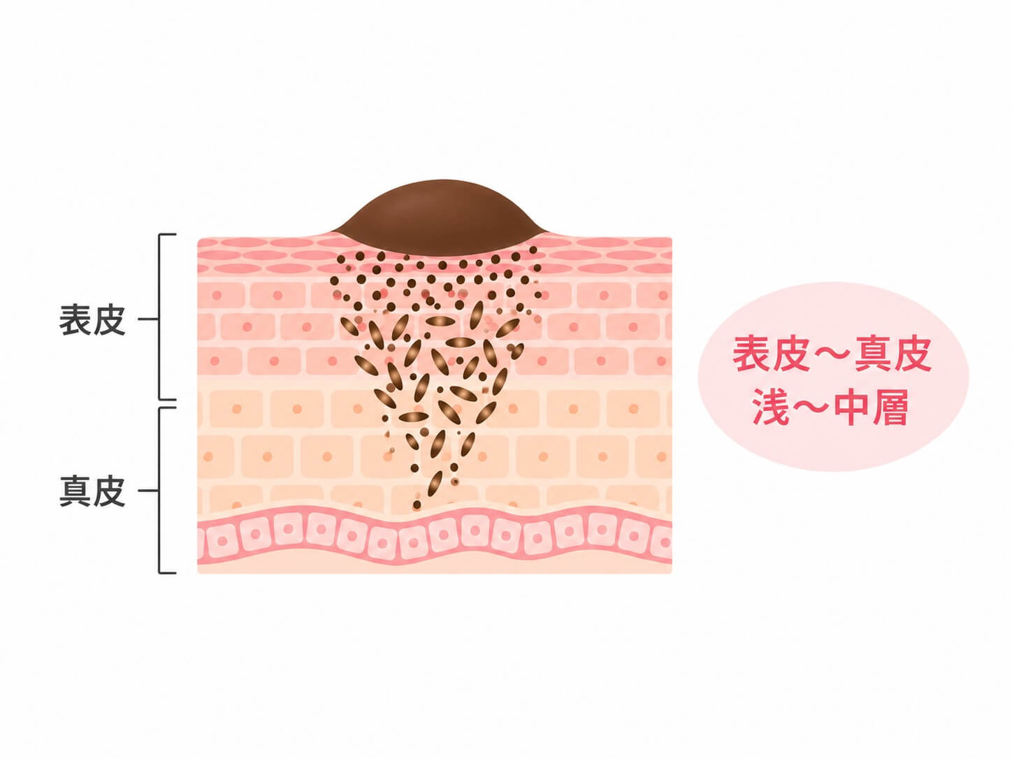 ホクロの深さを示す皮膚断面図