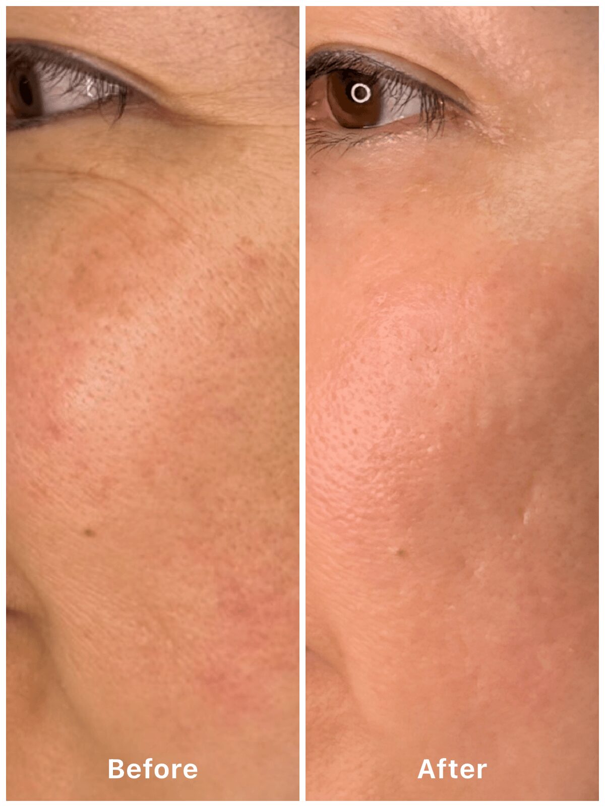 Before and after PicoSure Pico Premium treatment for facial pigmentation at Ueno Clinic Nagano