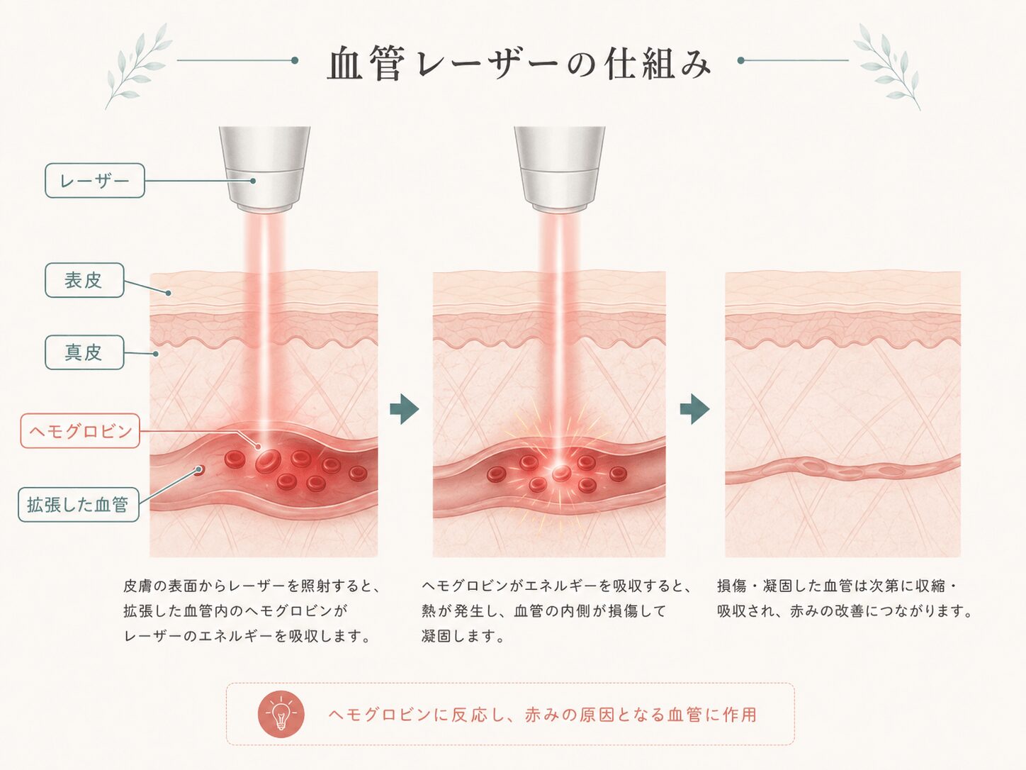 血管レーザーの仕組み：レーザーが血管内のヘモグロビンに反応し赤みの原因となる血管に作用する図解