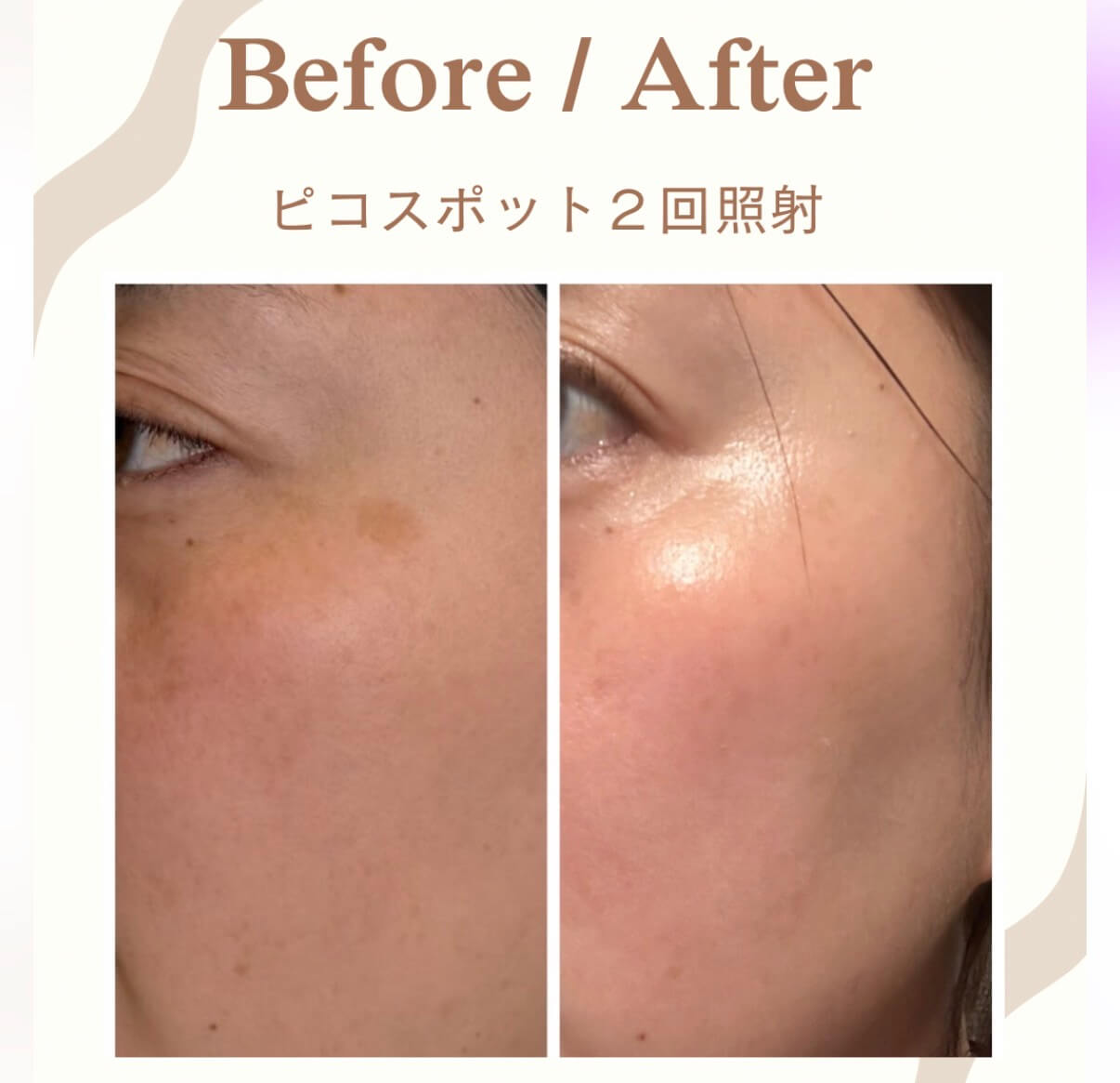 Before and after two Pico Spot laser sessions for cheek spots at Ueno Clinic Nagano