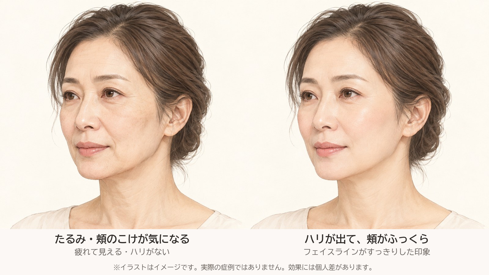 たるみ・頬のこけが気になる状態と、ハリが出た状態のイメージイラスト(実際の症例ではありません)